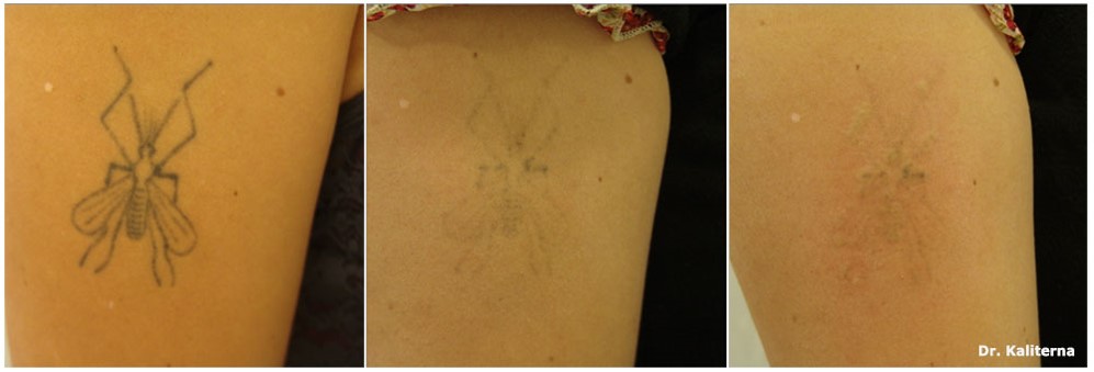 laserowe usuwanie tatuazy